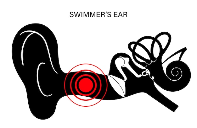 Vector swimmers ear otitis