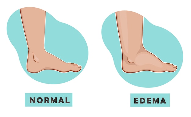 A swollen foot and ankle and a normal foot.