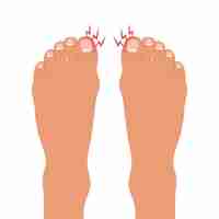 Vector swollen toe onychocryptosis foot with nail disease or infection foot with onychomycosis