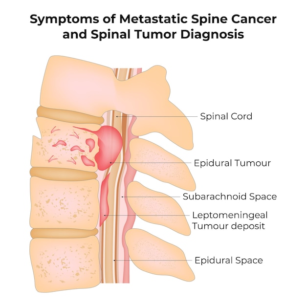 symptoms of metastatic spine cancer and spinal timor diagnosis