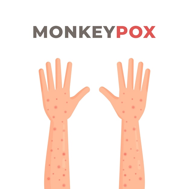 Symptoms of monkeypox monkeypox epidemic in africa and spain