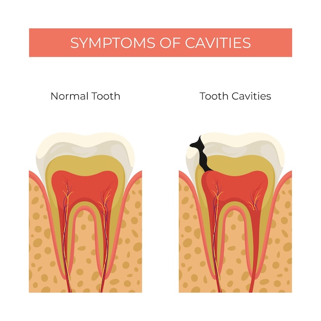 ベクトル 人間の歯穴の症状 普通の歯と歯穴の比較