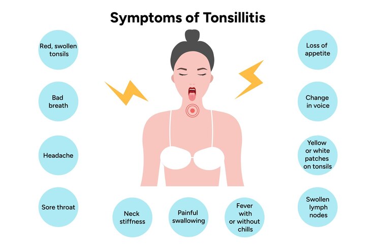 Vector symptoms of tonsillitis