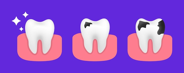 Tandbederf. slechte tand. gezondheidszorg. stadia van ontwikkeling van cariës, ernst van vernietiging. tand met cariës en gezonde tand. tandheelkundige zorg vector afbeelding