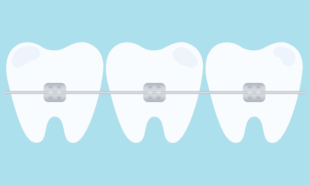 Tanden met beugels tandbeugels orthodontische tandheelkunde platte vectorillustratie