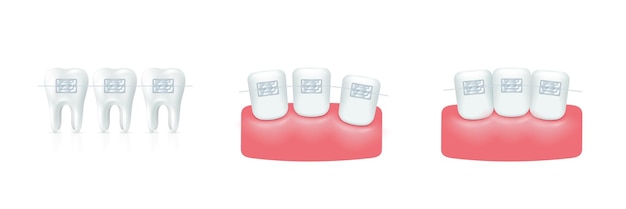 Tanden met beugelset Orthodontische tandheelkunde Uitlijning van tand Gezonde levensstijl en tandheelkundige zorg