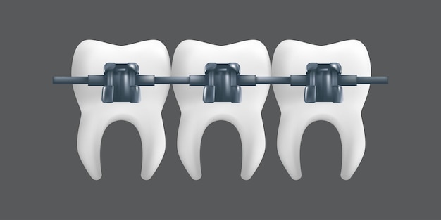 Tanden met metalen beugels. Orthodontische behandeling concept. realistische afbeelding van een tandheelkundig keramisch model geïsoleerd op een grijze achtergrond