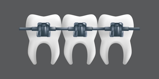 Tanden met metalen beugels. orthodontische behandeling concept. realistische afbeelding van een tandheelkundig keramisch model geïsoleerd op een grijze achtergrond