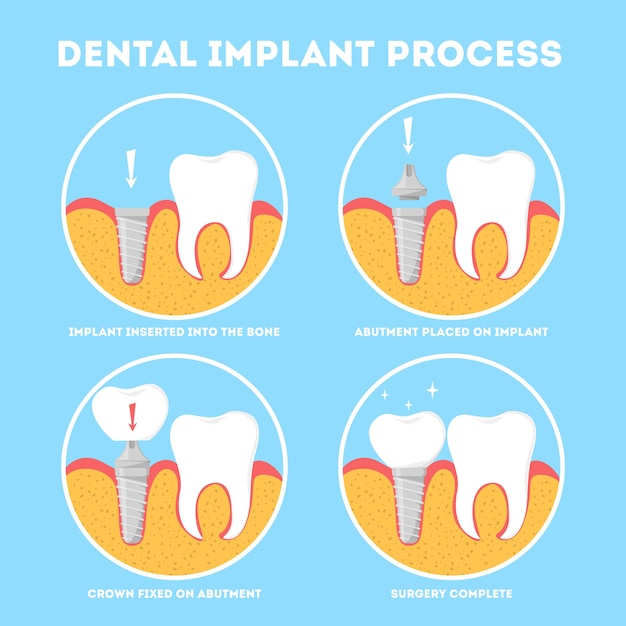 Tandheelkundig implantaatproces. medische behandeling en tandheelkunde.