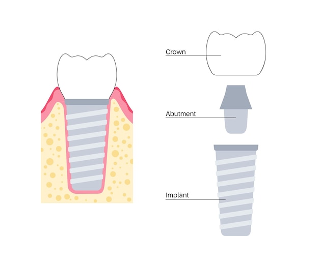 Tandheelkundige implantaatprocedure