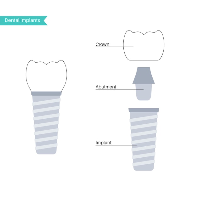 Tandheelkundige implantaatprocedure