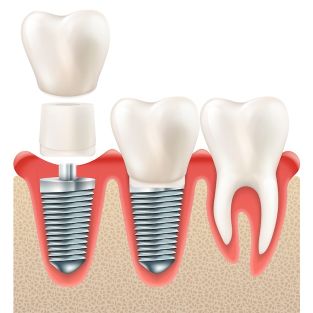 Vector tandheelkundige implantaatset.