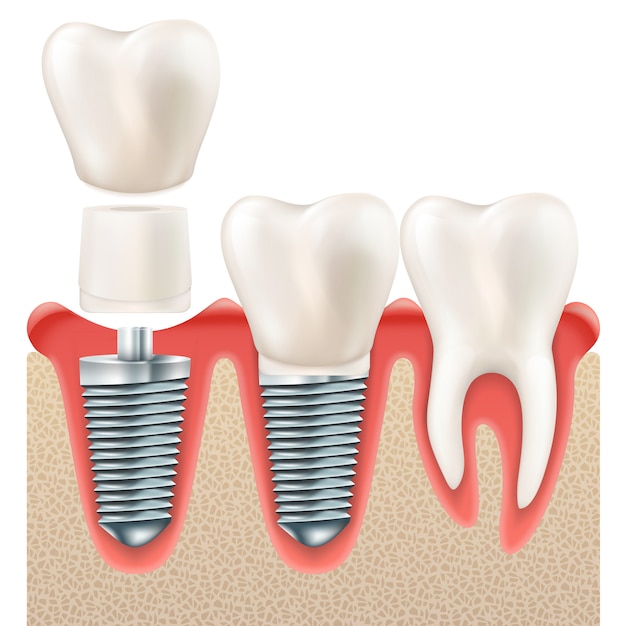 Tandheelkundige implantaatset.