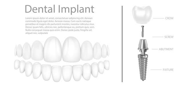 Tandheelkundige implantatenstructuur medische illustratieve educatieve infografische poster