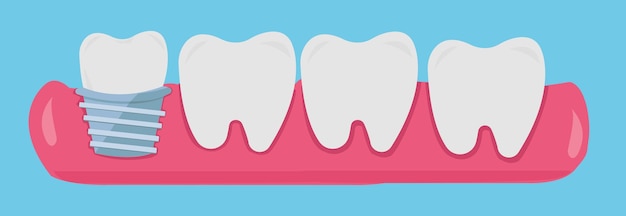 Vector tandimplantaten tandvectorillustratieset