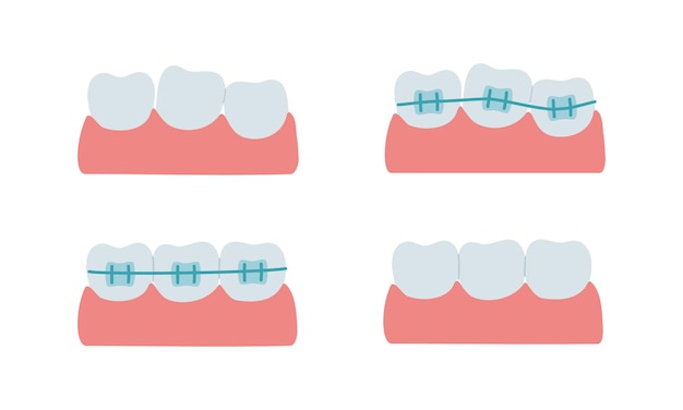 Vector teeth alignment with dental braces