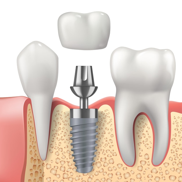 Vettore progettazione realistica dei denti e dell'impianto dentale dell'odontoiatria