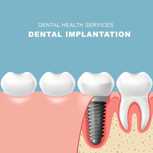 Denti e impianto dentale inseriti nell'impianto gengivale