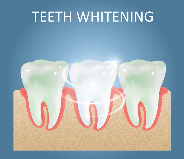 歯のホワイトニングベクトル医療ポスターデザインテンプレート