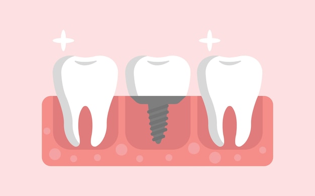 Vettore denti con impianto dentale inserito nell'illustrazione vettoriale gengivale