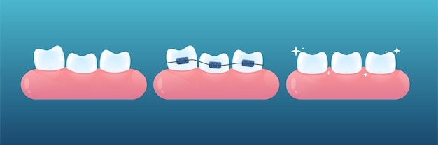 Teeth with or without braces. orthodontic dentistry. brace correction concept. vector cartoon style