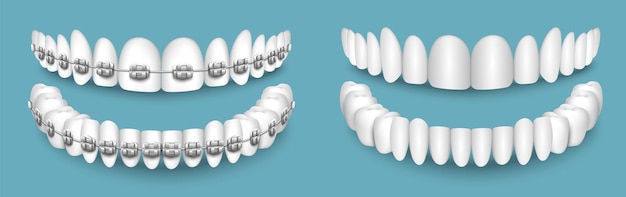 Vettore denti con o senza apparecchio odontoiatria ortodontica