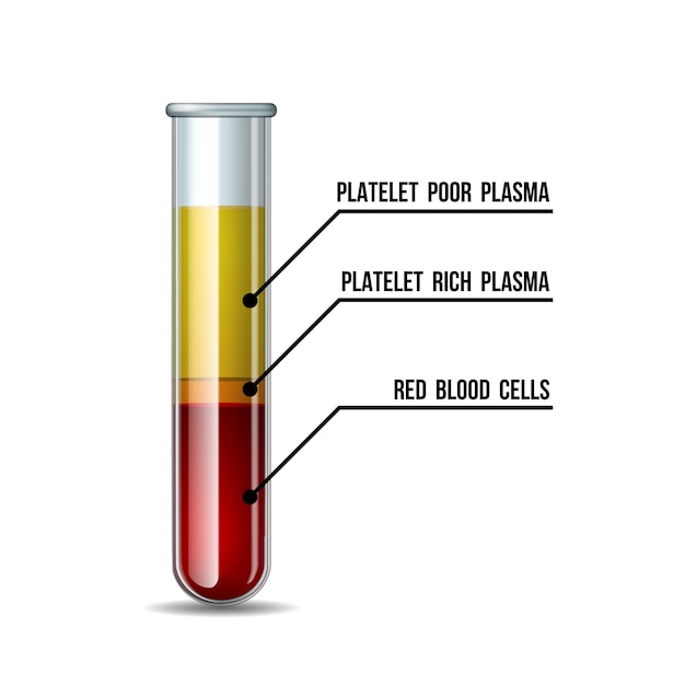 Provetta riempita di sangue dopo la centrifuga per procedure di iniezione prp.