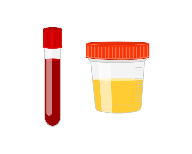 血液と尿のサンプル容器が入った試験管尿検査血液医学分析