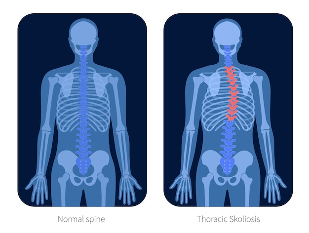 Thoracale scoliose op X Ray vectorillustratie. Ruggengraat krommingen en gezonde ruggengraat