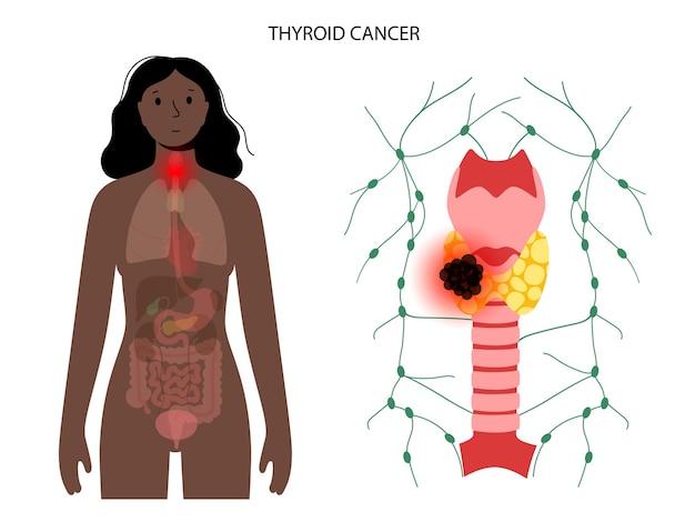 Vector thyroid cancer stages