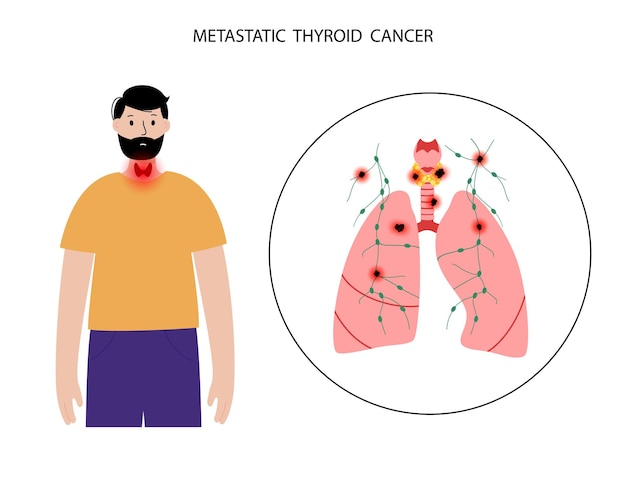 Vector thyroid cancer stages