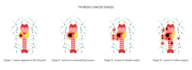 Vector thyroid cancer stages