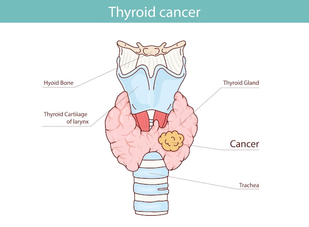 thyroid cancer vector anatomical illustration hand drawn in cartoon style