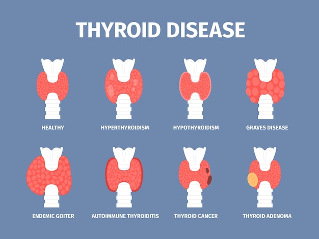 Vector thyroid gland various diseases goiter and hyperthyroid inflammation trachea icons endocrinology disease cancer and thyroiditis recent vector set of thyroid health and disease illustration