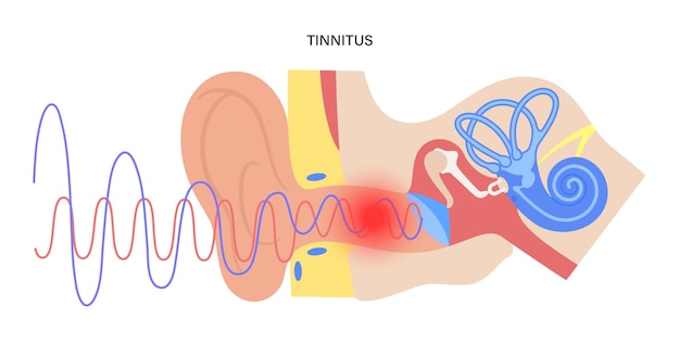 Vettore concetto di malattia dell'acufene