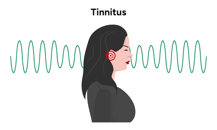 Vector tinnitus noise in human ear buzzing and dizziness disease