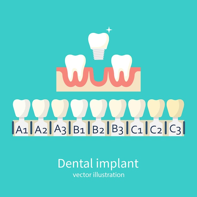 Tinten van implantaten Kunstgebit en implantaat productie tanden kleurstalen Veneers Implantaat tandheelkundige Vector illustratie plat ontwerp Geïsoleerd op witte achtergrond