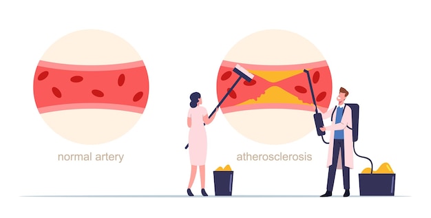 Tiny medic characters cleaning human blood artery of cholesterol plaque formation