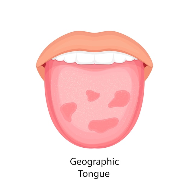 Vector tongue disease organs concept vector