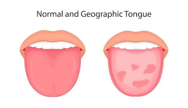 혀 질환 기관 개념 벡터