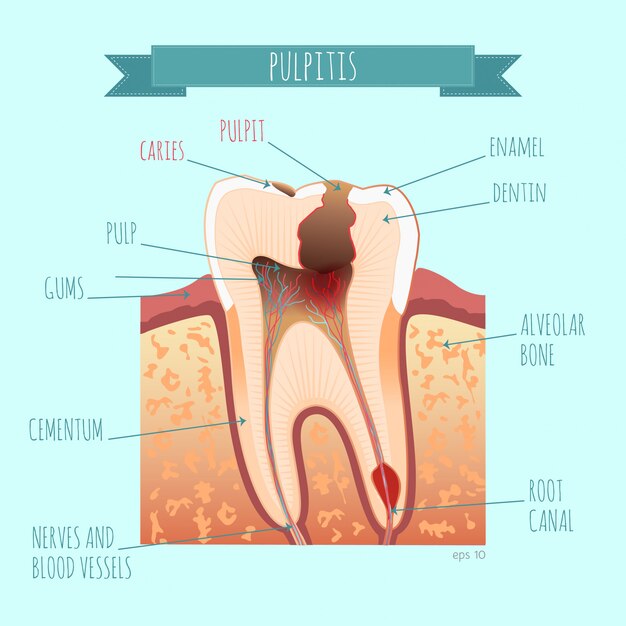 Vettore anatomia del dente. carie. pulpite