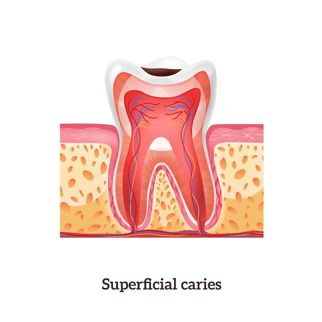 Tooth anatomy with superficial caries