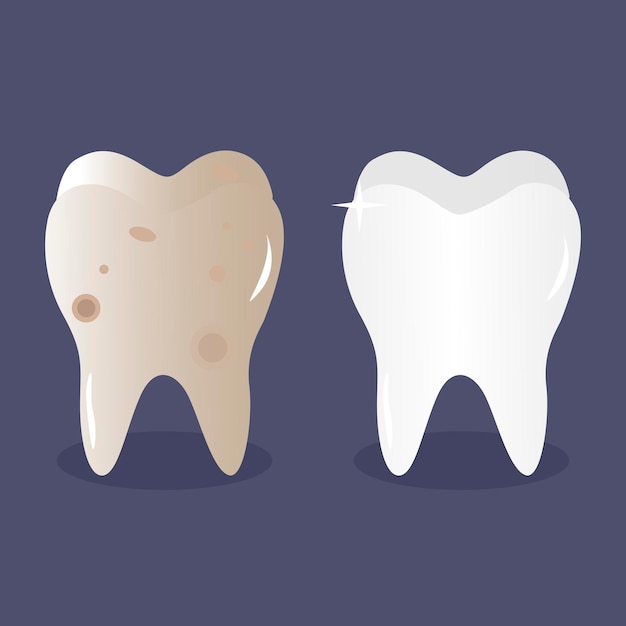 Dente prima e dopo lo sbiancamento e la pulizia