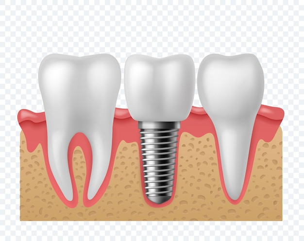 Tooth implant. Human teeth and dental implant, denture orthodontic technology. Artificial teeth dentistry implantation jaw. stomatology vector concept isolated o