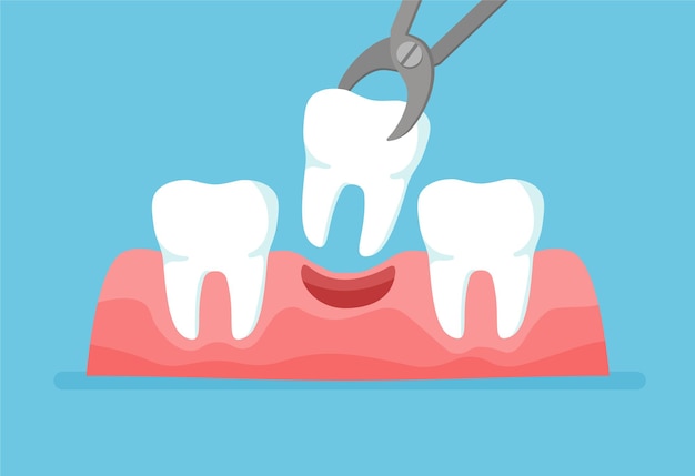 Vector tooth is removed by forceps teeth row with dental implant vector illustration isolated