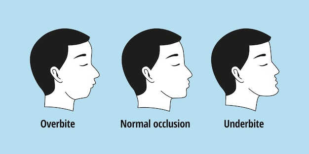 tooth problem. side view man with misaligned teeth. malocclusion