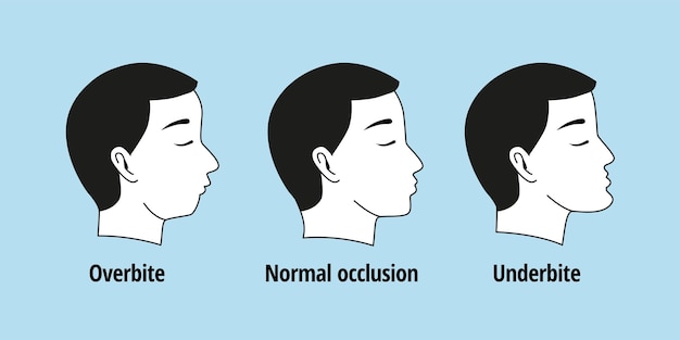 Tooth problem. side view man with misaligned teeth. malocclusion