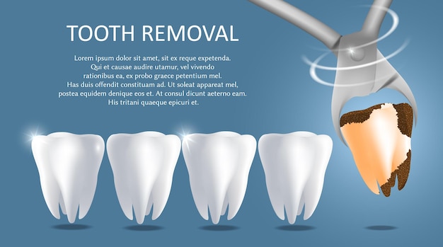 Modello banner poster medico vettoriale per la rimozione dei denti denti bianchi sani e dente cattivo estratti con pinze dentali procedura di estrazione del dente concetto di chirurgia dentale