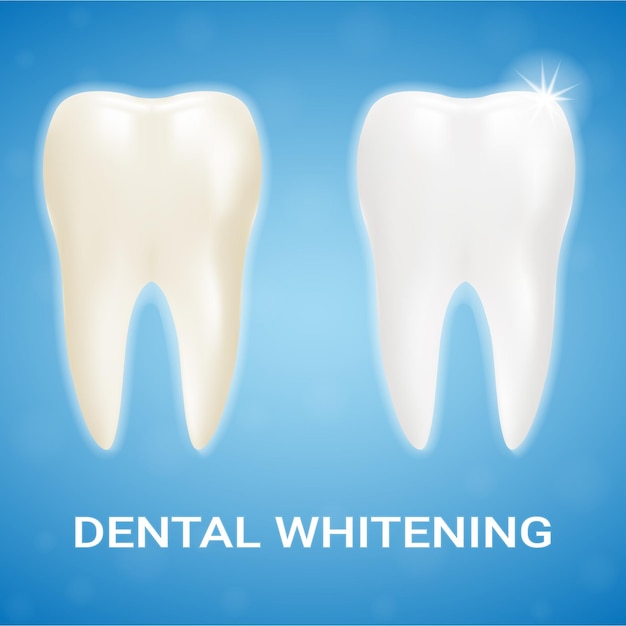 歯のベニア歯のホワイトニングホワイトニング歯磨き粉を背景に分離現実的なベクトル図