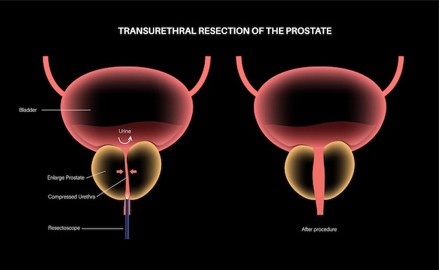 Transurethrale resectie van de prostaat TURP medische procedure Chirurgische verwijdering van een deel van de prostaat BPH behandeling medische poster Anatomische medische poster van blaas vectorillustratie